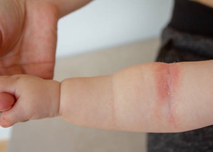 Dein Weg aus der Neurodermitis - für Babys und Kleinkinder!